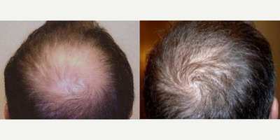 Hair Transplant before and after photo