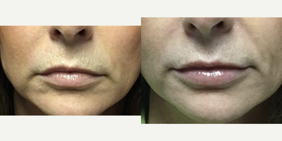Juvederm before and after photo