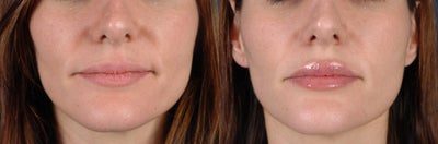 Lip Fillers before and after photo