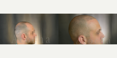 Scalp Micropigmentation before and after photo