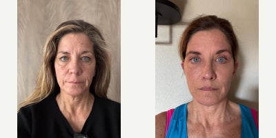Facelift before and after photo