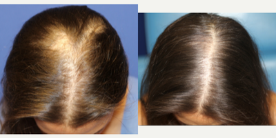 Hair Transplant before and after photo