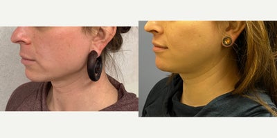 Lip Lift before and after photo