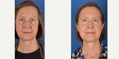 Ultherapy before and after photo