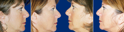 Eyelid Surgery before and after photo