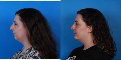Rhinoplasty before and after photo