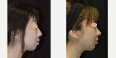 Asian Rhinoplasty before and after photo