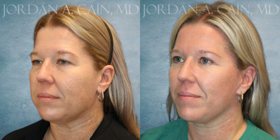Brow Lift before and after photo