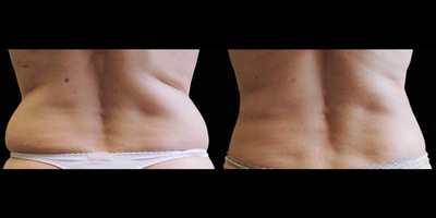 CoolSculpting before and after photo