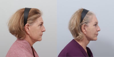 Deep Plane Facelift before and after photo