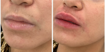 Lip Fillers before and after photo