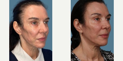 Sculptra before and after photo