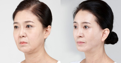 SMAS Facelift before and after photo