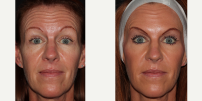 Botox before and after photo