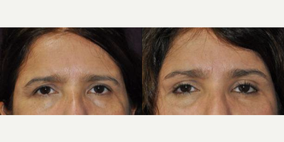 Brow Lift before and after photo
