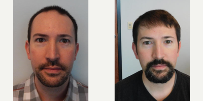 Hair Transplant before and after photo