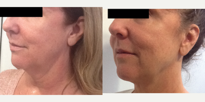 Kybella before and after photo
