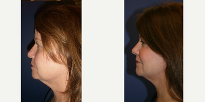 Kybella before and after photo