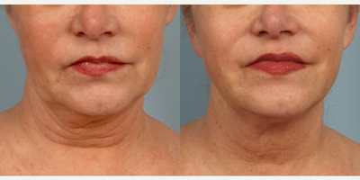Laser Liposuction before and after photo
