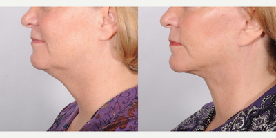 Facelift before and after photo