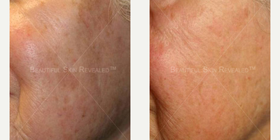 Laser Resurfacing before and after photo