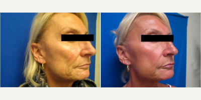 Sculptra before and after photo