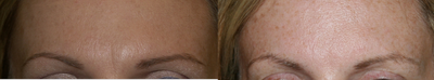 Botox before and after photo