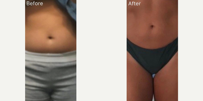 CoolSculpting before and after photo