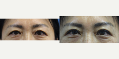 Double Eyelid Surgery before and after photo