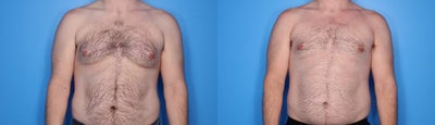 Gynecomastia Surgery before and after photo