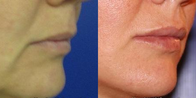 Juvederm before and after photo