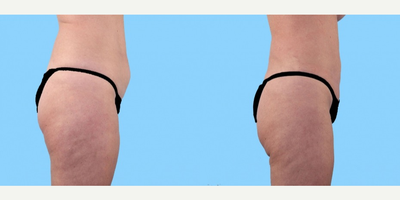 Liposuction before and after photo