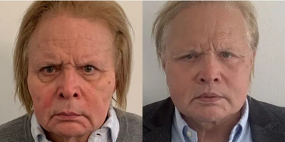 Neck Lift before and after photo
