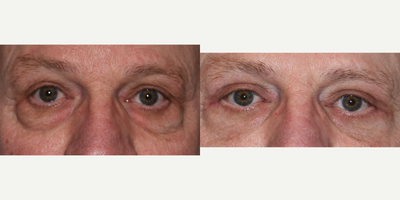 Eyelid Surgery before and after photo