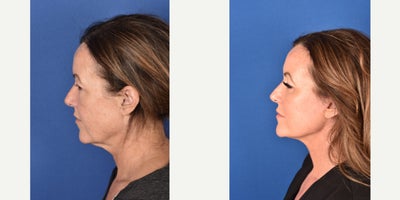 Facelift before and after photo