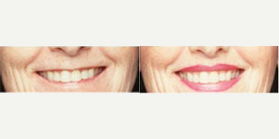 Lip Fillers before and after photo