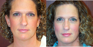 Rhinoplasty before and after photo