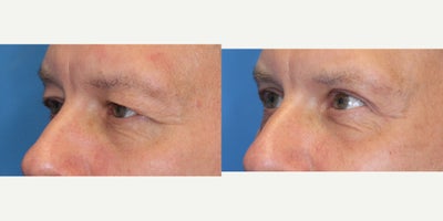 Eyelid Surgery before and after photo