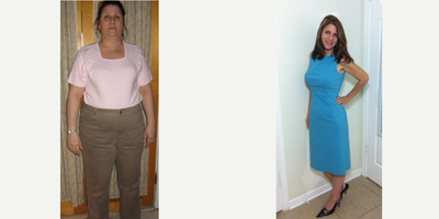 Gastric Bypass before and after photo