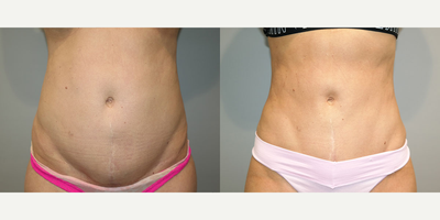 Liposuction before and after photo