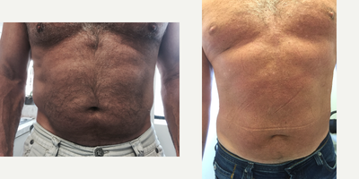 Diastasis Recti Repair before and after photo
