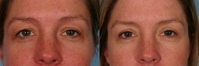 Eyelid Surgery before and after photo