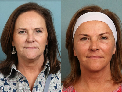Brow Lift before and after photo