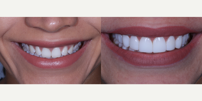Dental Bonding before and after photo