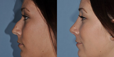 Rhinoplasty before and after photo