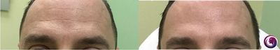Botox before and after photo