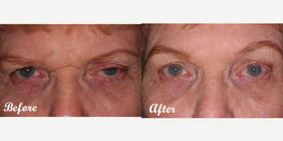 Brow Lift before and after photo