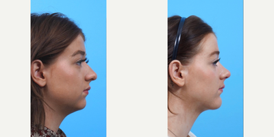 Chin Implant before and after photo
