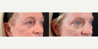 Eyelid Surgery before and after photo