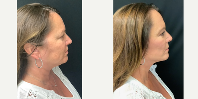 Facelift before and after photo